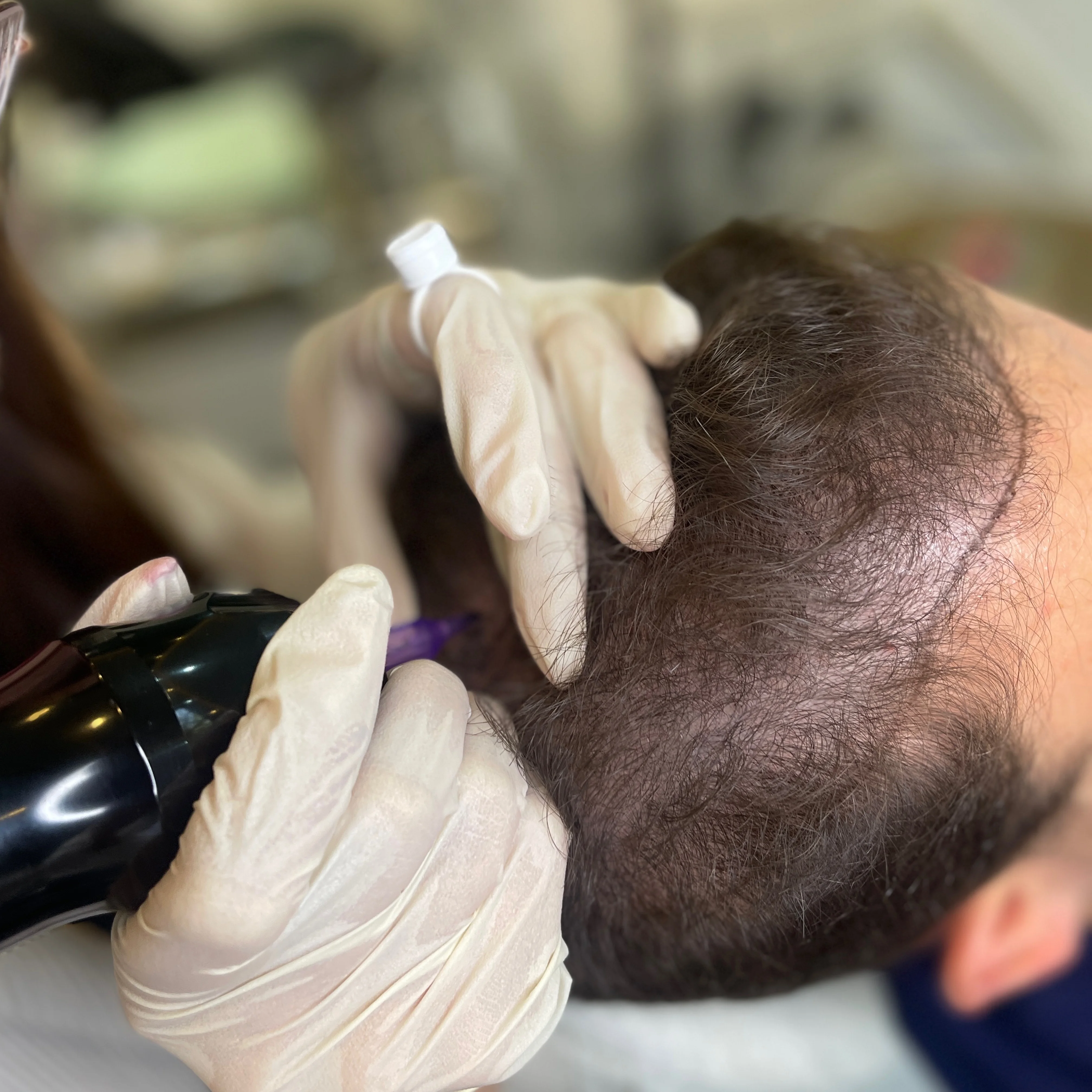 میکرواسکالپ سر راهکاری نوین برای رفع کم‌پشتی مو